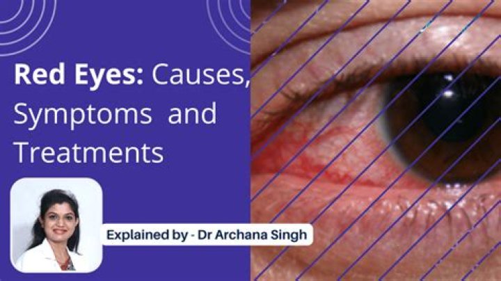 19 Red Eye Causes and How to Treat Red Eyes