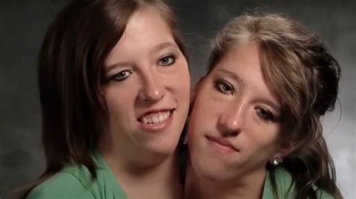 Abby And Brittany Conjoined Twins Death: A Comprehensive Overview