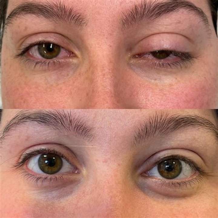 Botox and Droopy Eyelids: Causes and Treatment