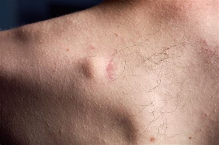Bultos de grasa en la espalda: ¿qué provoca su aparición?