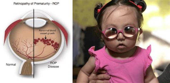 Can a Preterm Birth Cause Myopia? How?