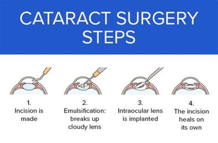 Can Cataract Surgery Be Redone?