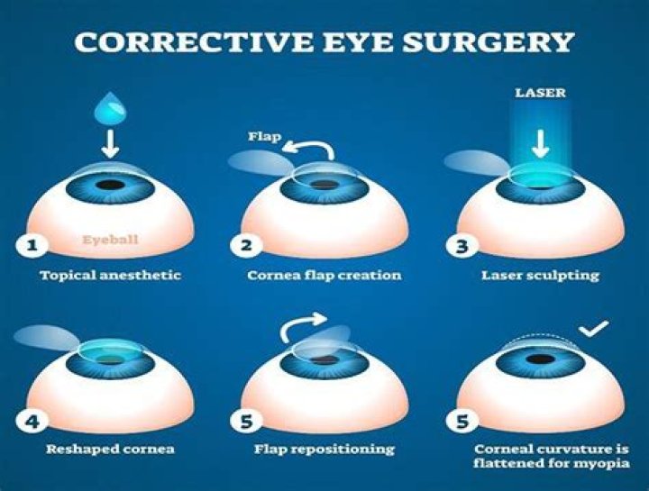 Can LASIK Correct a Lazy Eye?