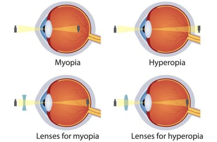 Can Myopia Be Reversed? - All About Vision