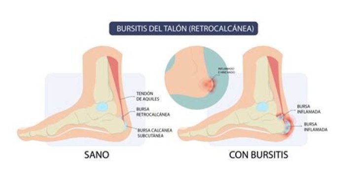 Causas por las que duele el talón
