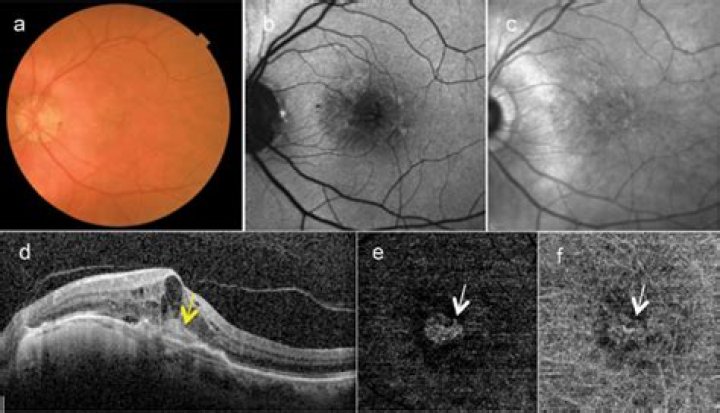 Choroidal Neovascularization (CNV)