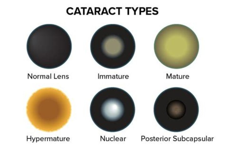 Congenital Cataracts, Types, Causes and Treatments