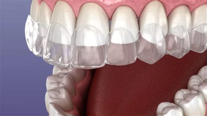 Conoce los riesgos de adquirir ortodoncia invisible en internet