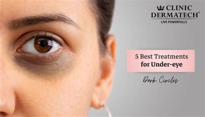 Dark Circles Under the Eyes: Causes and Treatments