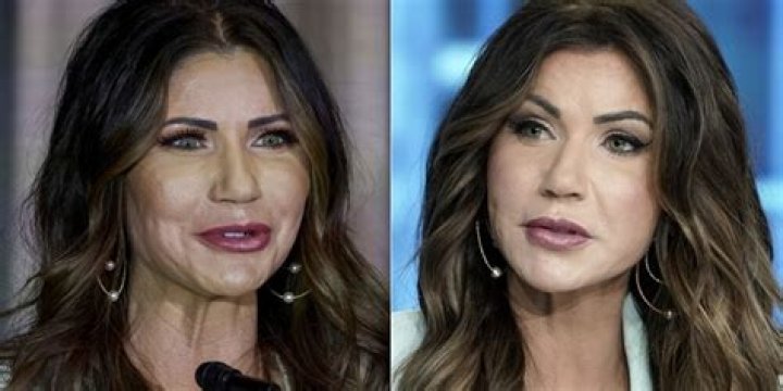 Did Kristi Noem Have Plastic Surgery? Unveiling The Truth Behind The Rumors