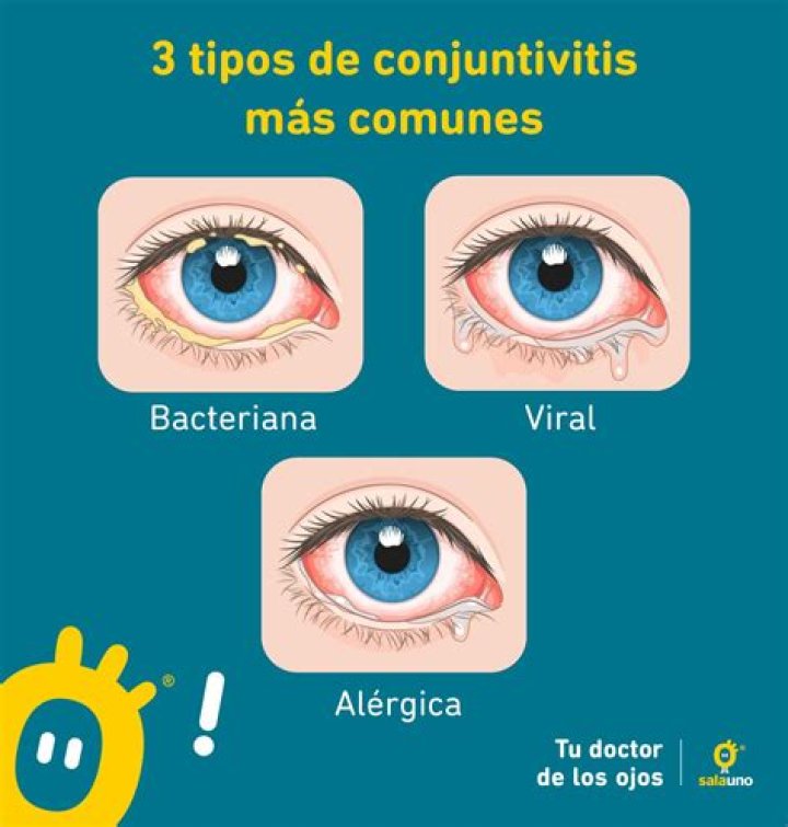 ¿El coronavirus (o un resfrío o una gripe) puede causar conjuntivitis?