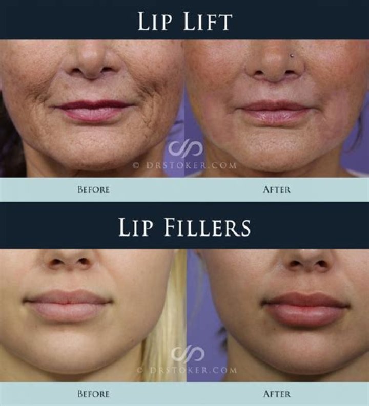 Everything to Know About Lip Lifts