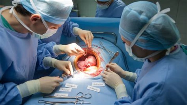Everything You Need to Know About Cesarean Sections