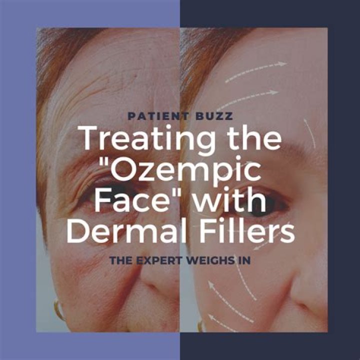 Exploring The Relationship Between Ozempic And Lupus