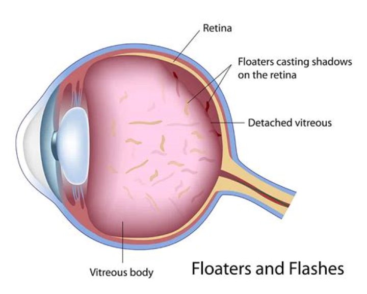 Eye floaters treatment - All About Vision
