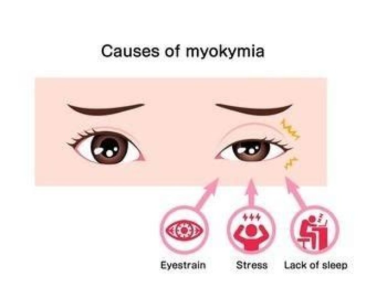 Eye twitching | 8 causes of myokymia
