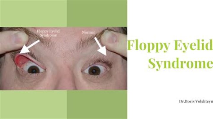 Floppy Eyelid Syndrome - Causes, Diagnosis, Treatment