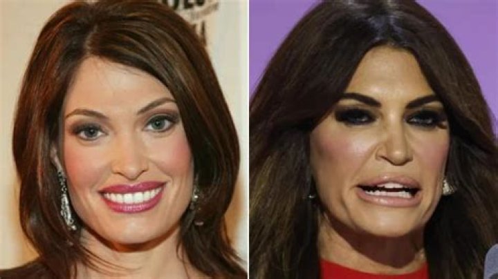 Has Kimberly Guilfoyle Had Plastic Surgery? A Comprehensive Look