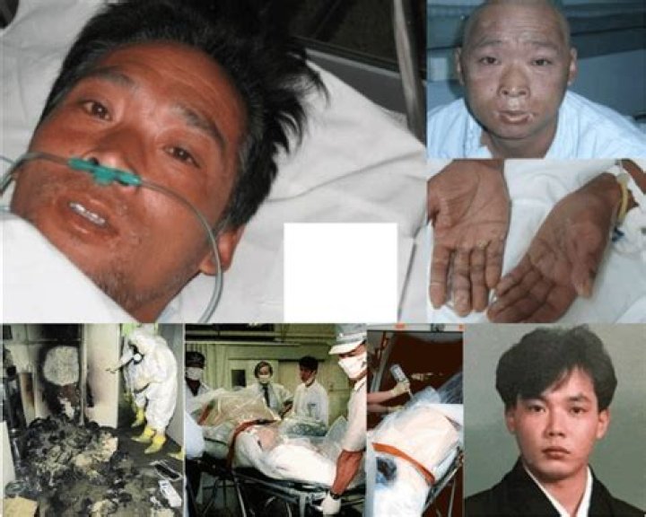 Hisashi Ouchi After Photos: A Journey Of Survival And Resilience