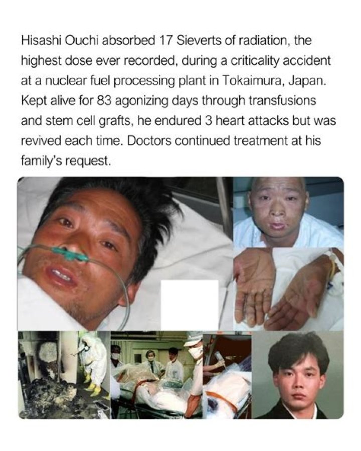 Hisashi Ouchi Hospital: A Case Study In Medical Ethics And Treatment