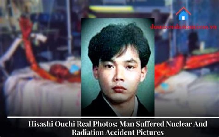 Hisashi Ouchi: The Real Photos And Tragic Story