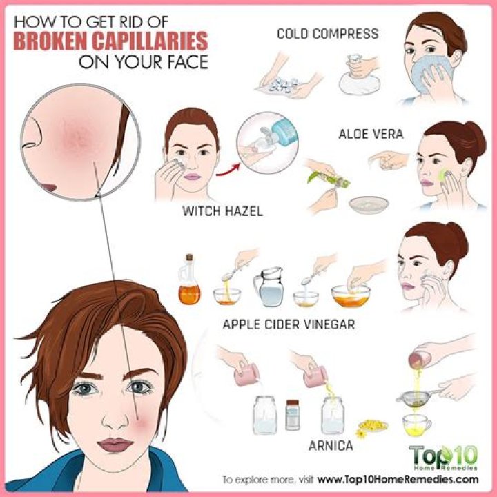 How to Get Rid of Broken Capillaries on Your Face