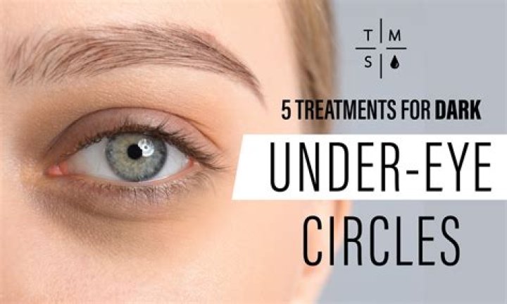 How to Get Rid of Dark Under-Eye Circles for Good