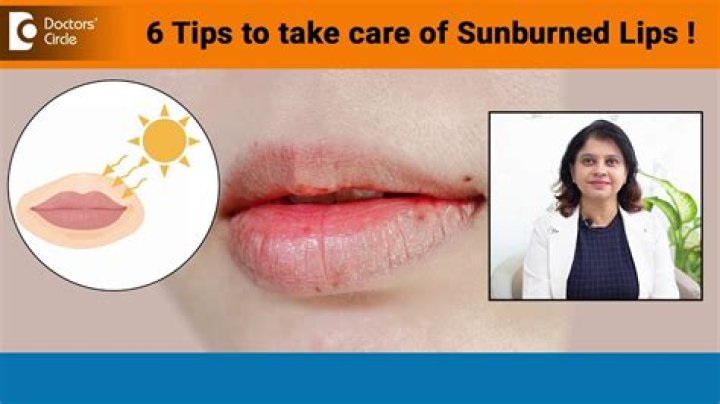How to Heal Sunburned Lips, According to the Experts