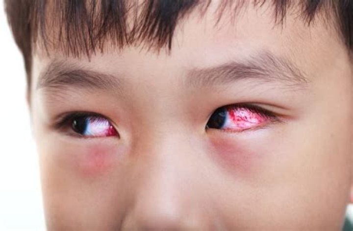 How to Prevent and Treat Red Eyes In Kids and Babies