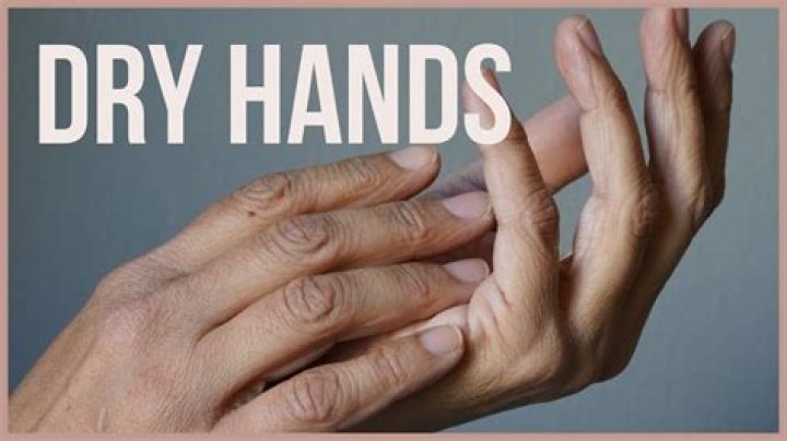 How to Treat Dry Hands, According to Experts