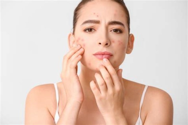 I'm Buying the $14 Skin Tint My Dermatologist Recommended for Flare-Ups