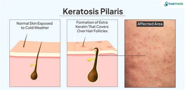 Keratosis Pilaris: Causes, Treatments, and More