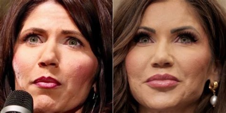 Kristi Noem Facelift: A Comprehensive Overview