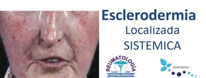 la esclerodermia y cómo vivir con ella