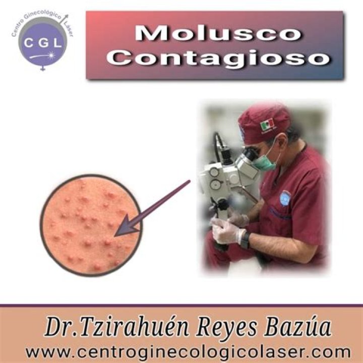 Los moluscos contagiosos, una infección de transmisión sexual