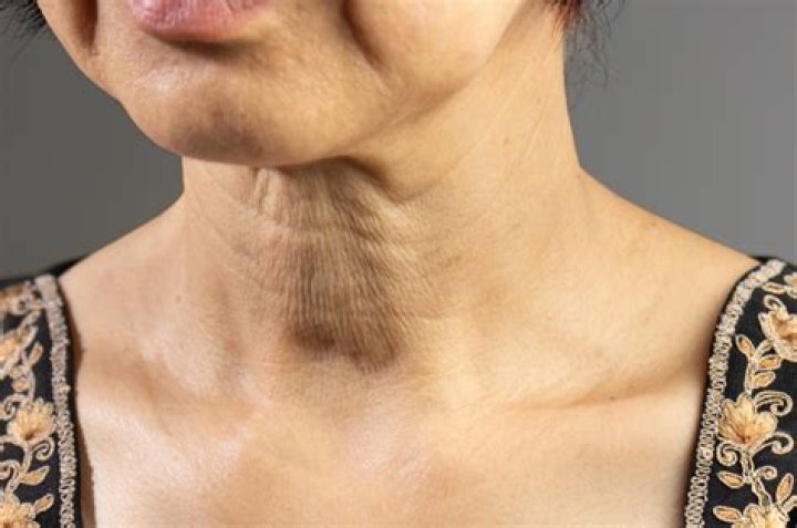 Neck Lines: Causes, Prevention, and Treatment