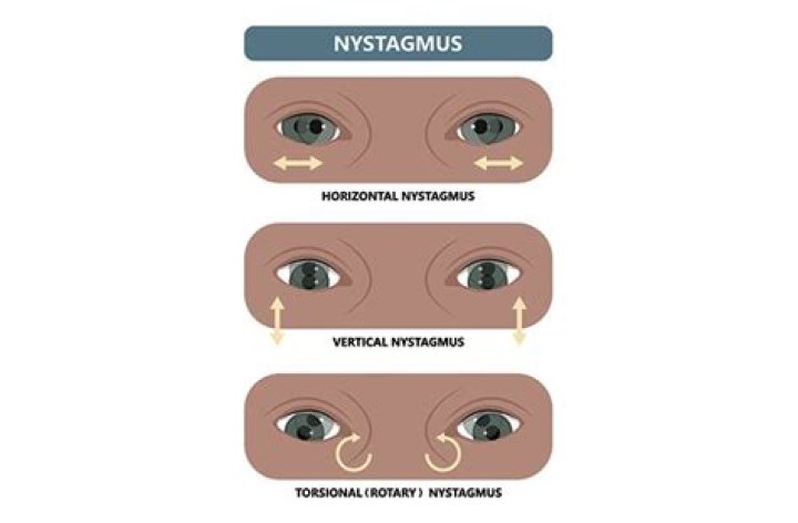 Nystagmus - All About Vision