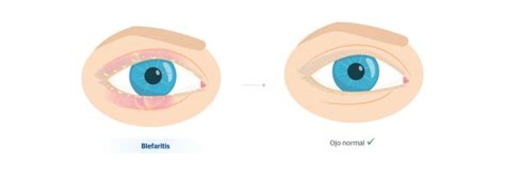 Ojos Hinchados en Niños: Síntomas, Causas y Tratamiento