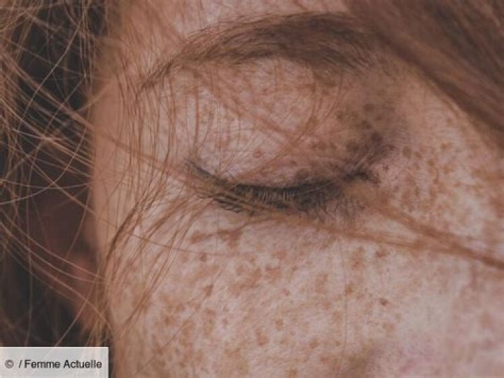 Pigmentation et grain de beauté dans l’œil