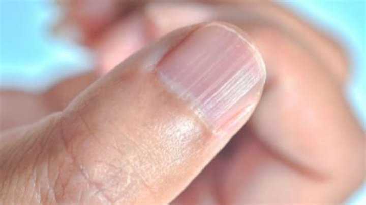 ¿Por qué aparecen las estrías en las uñas?