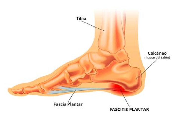 Qué es la fascitis plantar
