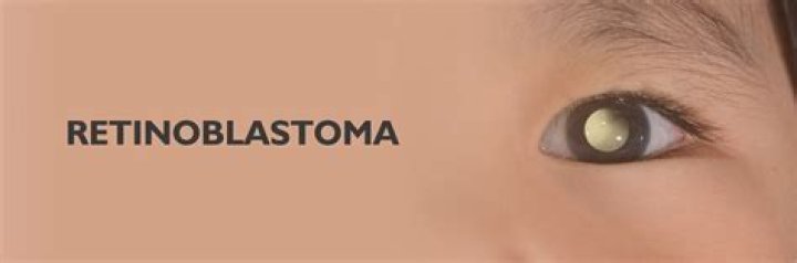 Retinoblastoma: Sintomas, causas, tratamentos
