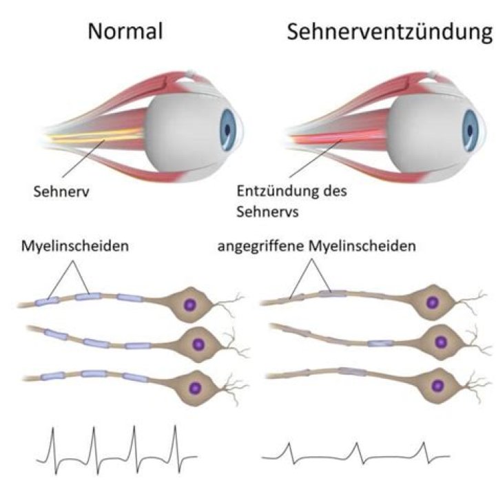 Sehnerventzündung (Optikusneuritis): Symptome & Behandlung