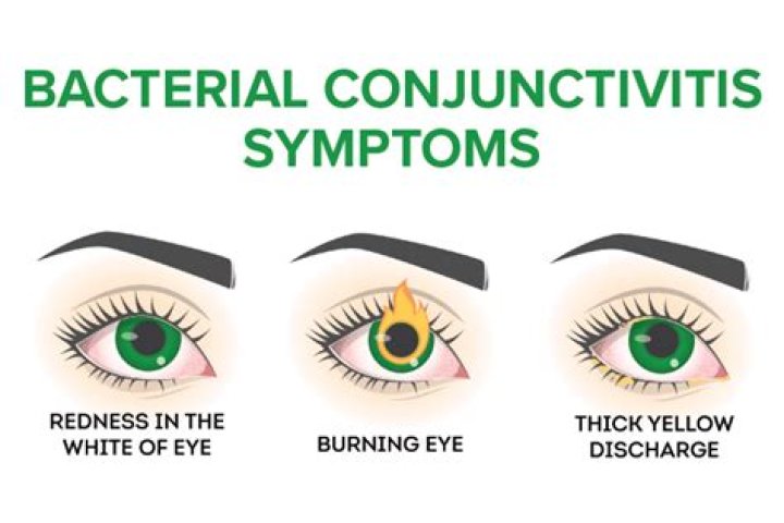 Signs and Symptoms of Pink Eye (Conjunctivitis)