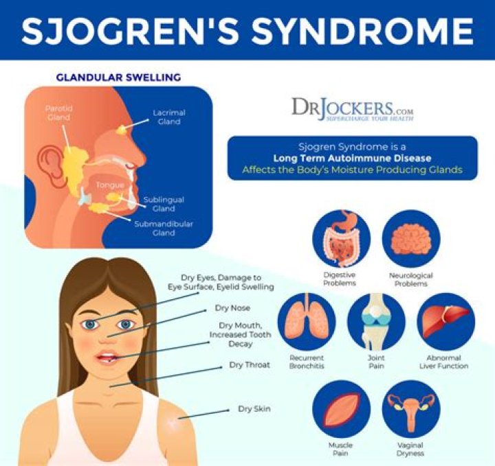Sjogren's Syndrome: What Is It?