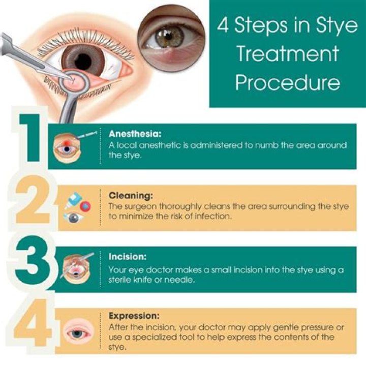 Stye Removal: Surgery and Other Treatments