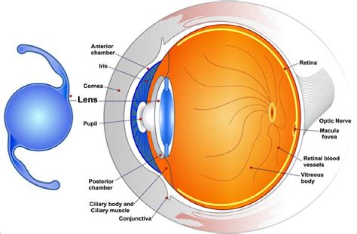 Toric IOL For Astigmatism Correction