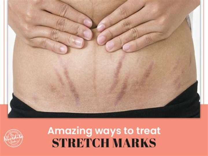 Turns Out You CAN Treat Your Stretch Marks