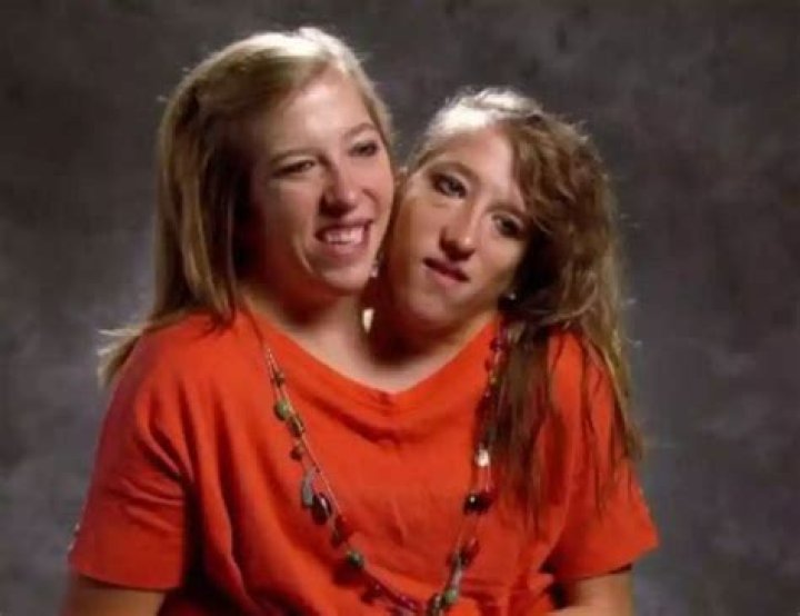 Understanding The Cause Of Death Of Abby And Brittany Hensel: A Comprehensive Overview