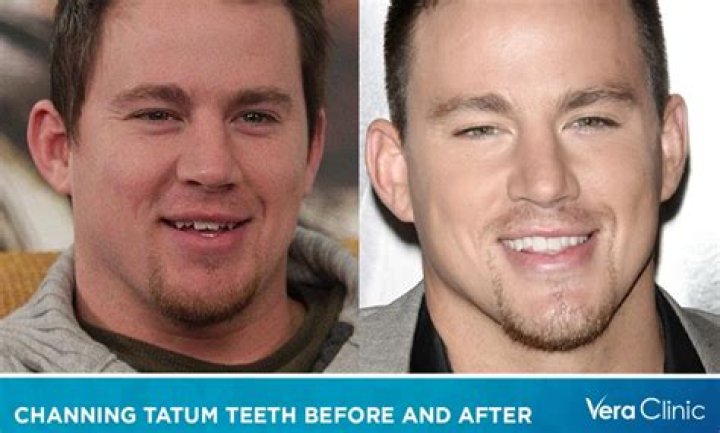 Unveiling Channing Tatum's Journey Through Hair Loss